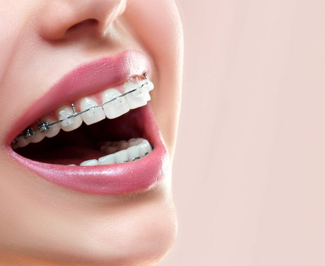 Traditional braces
